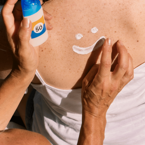 Pigmentvlekken in de zomer: hoe voorkom je dat ze donkerder worden?