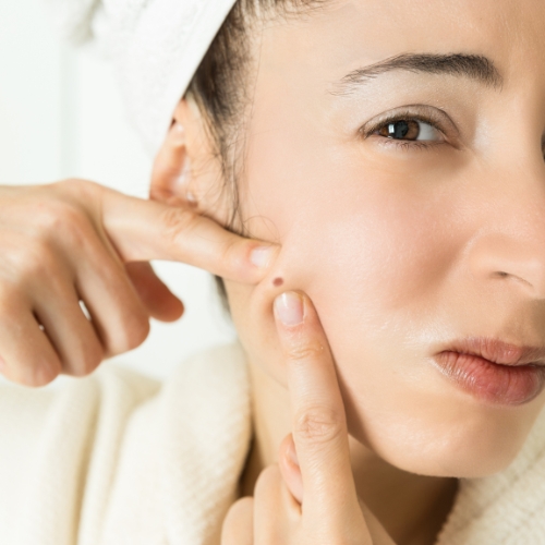 Wat is acne precies Wat is acne precies